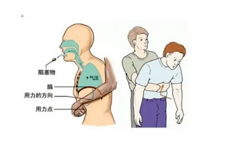 遇到異物卡住喉嚨，可采取海姆立克急救法。海姆立克急救法是科學(xué)解除氣道異物堵塞的急救方法，分為成人版操作和兒童版操作兩種急救方法(圖1)